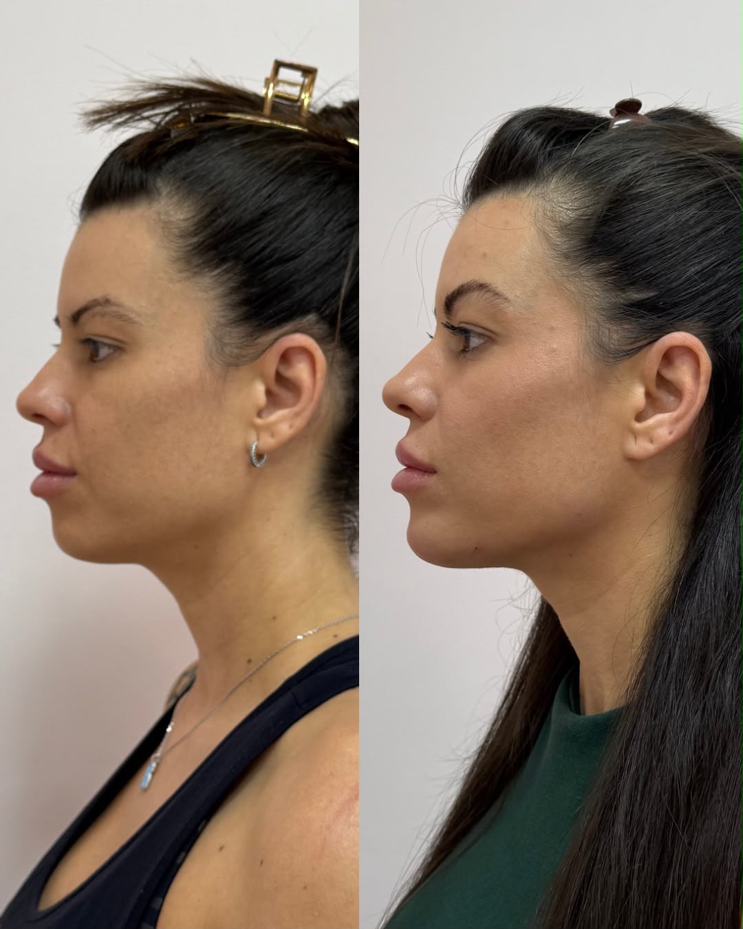 Caso 02 — Redefinição do contorno mandibular: antes e depois